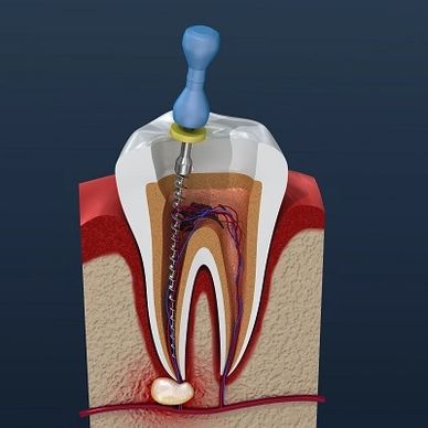 Root Canal, Implant, All On 4 Dental implant, Denture 