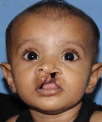 Child with unilateral Cleft Lip