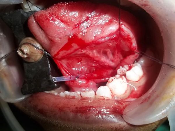 Ranula, Mucocele, mucose retention cyst, salivary gland, stenson's duct, cyst, minor oral surgery.