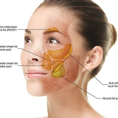 The Procedure of Buccal Pad Fat Removal