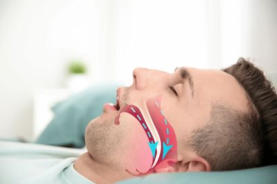 Sleep apnea