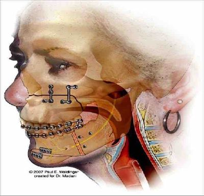 Jaw Correction Surgery, Orthognathic Surgery, Double Jaw Surgery (DJS)
