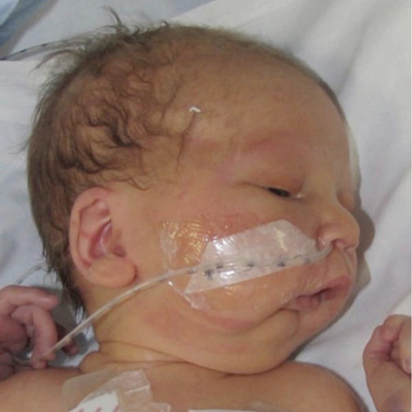 how to feed a cleft palate baby solids