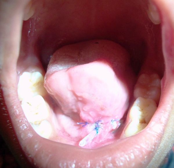 Ranula, Mucocele, mucose retention cyst, salivary gland, stenson's duct, cyst, minor oral surgery.