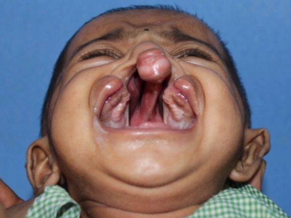 What is cleft lip and cleft palate