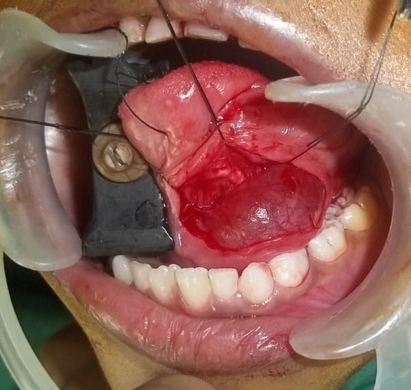 Ranula, Mucocele, mucose retention cyst, salivary gland, stenson's duct, cyst, minor oral surgery.
