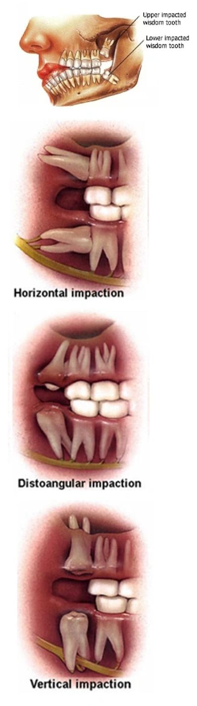 Learn What Will Happen if Wisdom Teeth are Not Removed