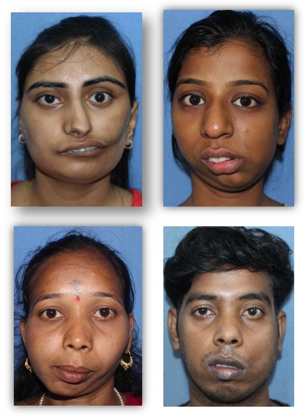 Therapy For Facial Palsy, Mumbai