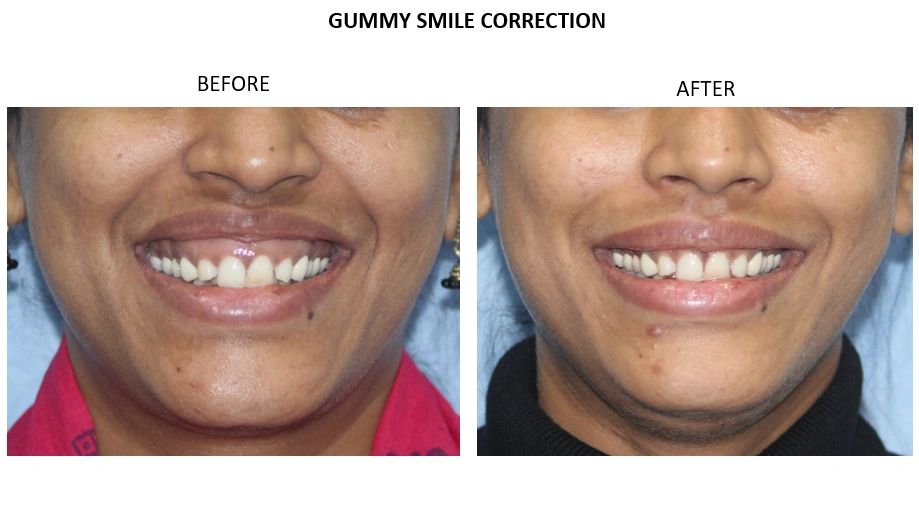 Gummy Smile Correction: Unveiling the Secret to a Dazzling Smile