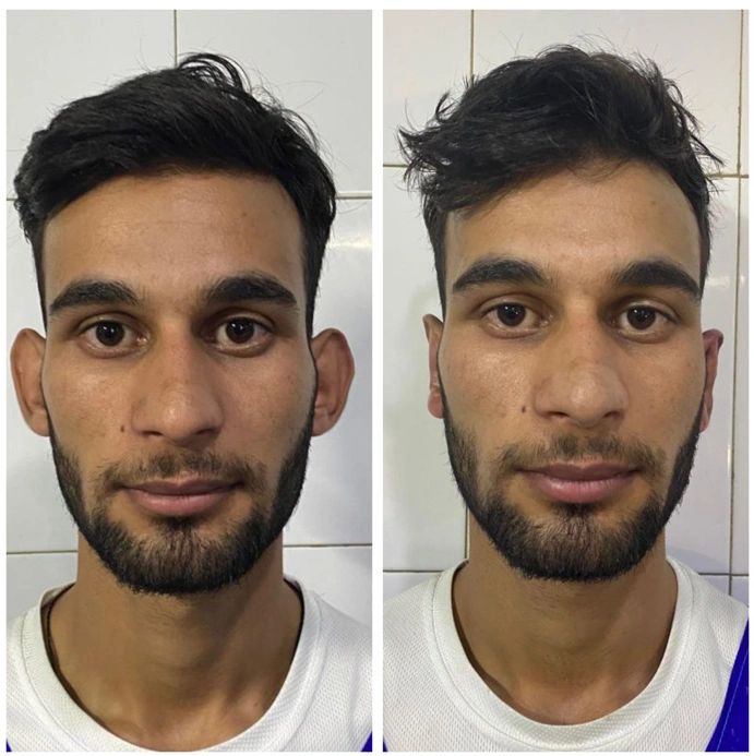 Without Surgery Non Surgical Otoplasty Cost Best Bat Ear