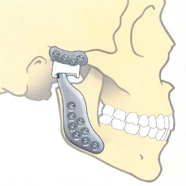 TMJ (temporomandibular Joint) Disorder Treatment/Replacement
