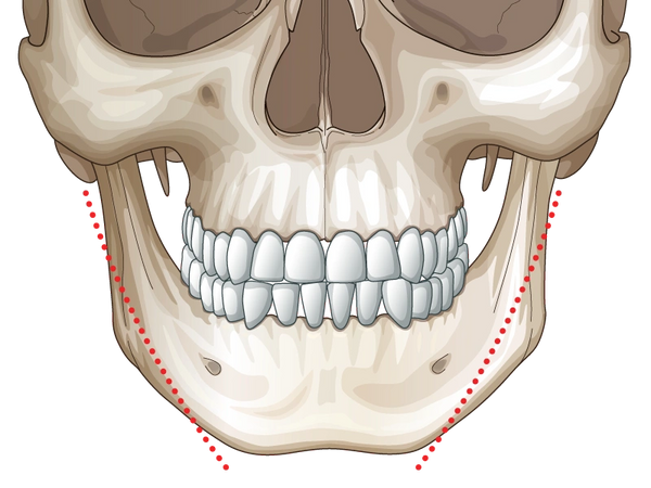 Jaw Recontouring, Angle Reduction, V-Line Face - Tes Clinic for Face and Jaw