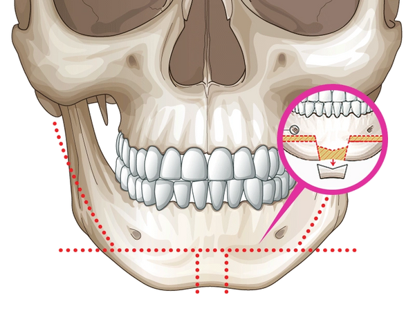 How much does facial bone contouring surgery cost in India?