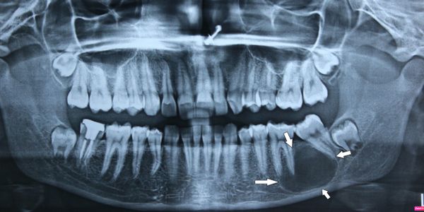 Nuface Cyst And Tumor Of Jaw And Face 6427