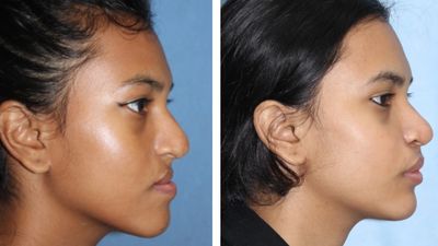 Jawline surgery