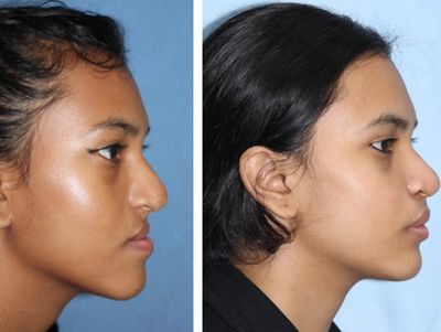 Jaw Correction Surgery  Before After