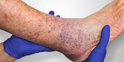 Venous Stasis Wounds | Vascular Surgical Specialists, PLLC
