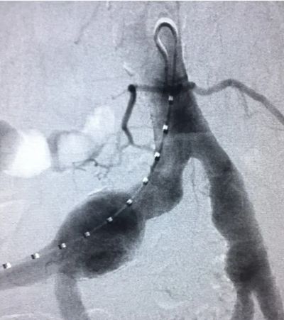 X-ray of an Abdominal Aortic Aneurysm
