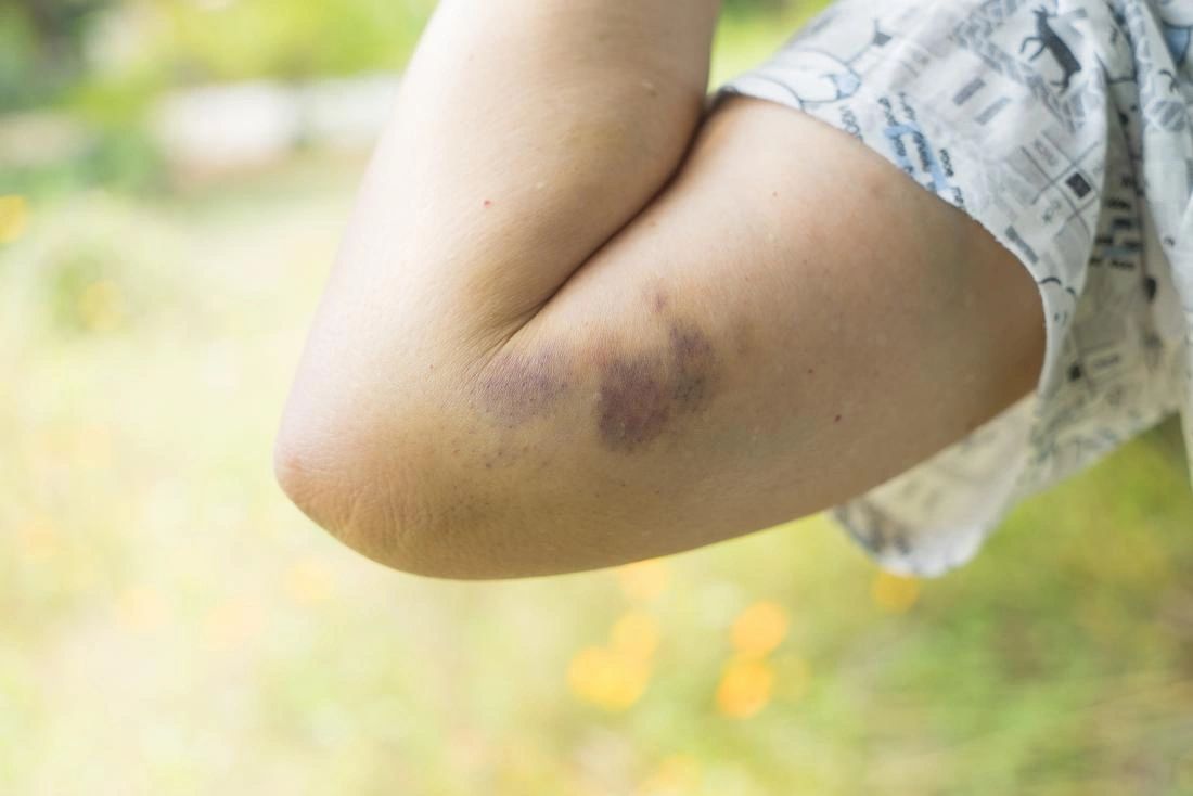 Primeros Auxilios Hematoma primeros-auxilios-hematoma