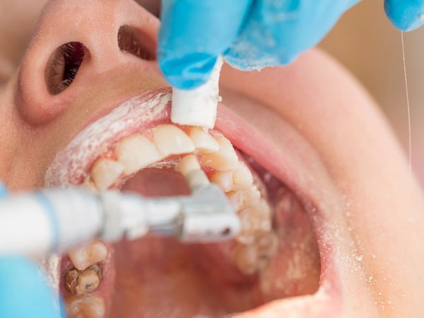 Limpieza dental con Ultrasonido