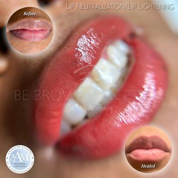 Lip neutralization before & after