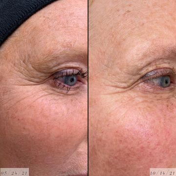 Micro-needling,microchannelling, skin resurfacing, scar treatment, Procell