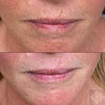 Micro-needling,microchannelling, skin resurfacing, scar treatment, Procell