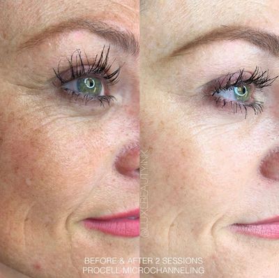 ProCell, Better than Botox, lasting results!  Results are permanent, yearly maintenance suggested.