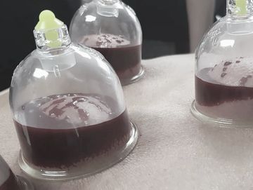 master tung chinese blood letting wet cupping hajama