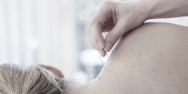 woman having acupuncture in trapezius muscle
