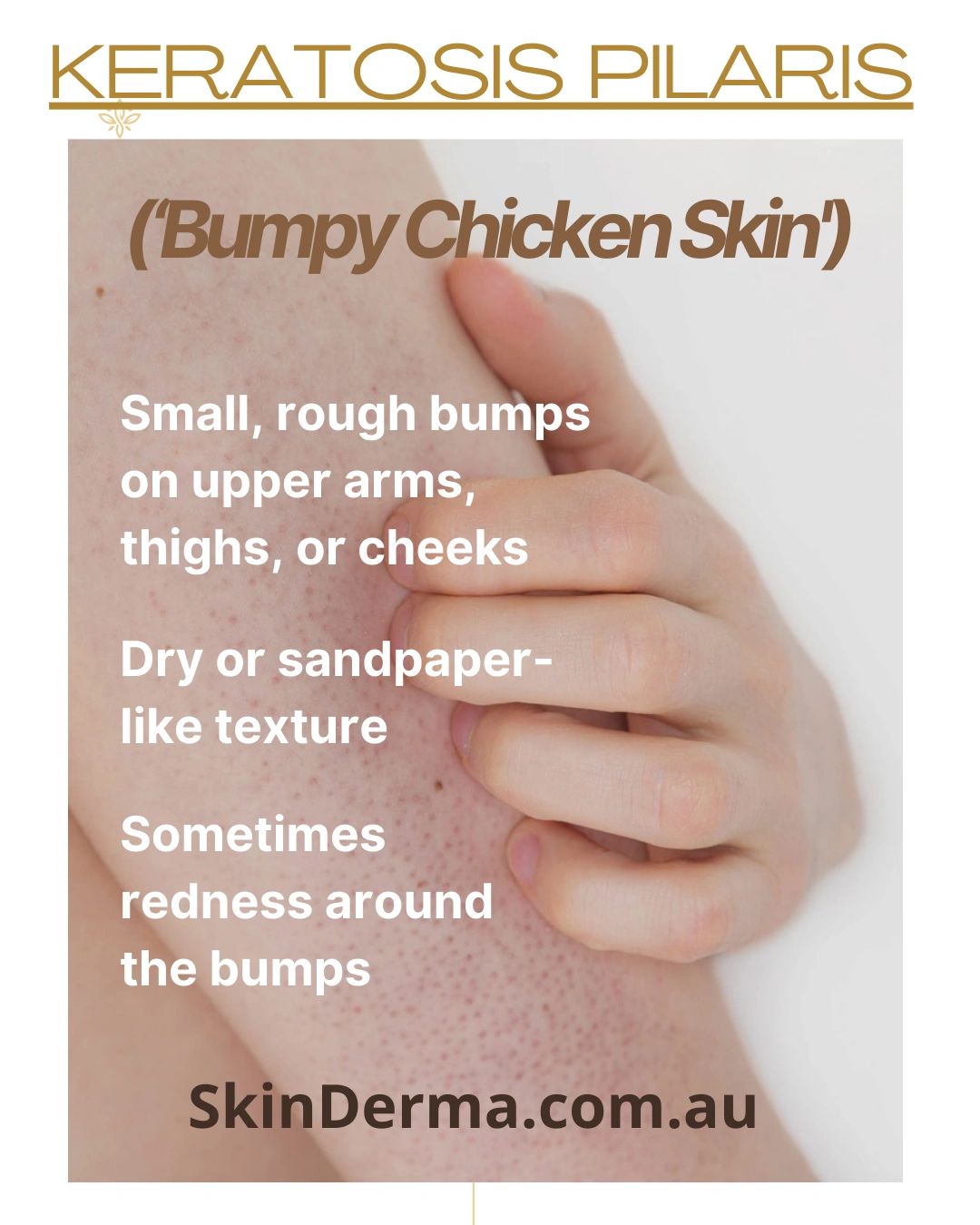 Keratosis Pilaris: Why Skin Gets Bumpy and How to Improve It