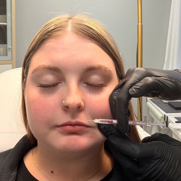 Client receiving a Lip Flip. A Lip Flip is a treatment performed by injecting Botox into the muscles