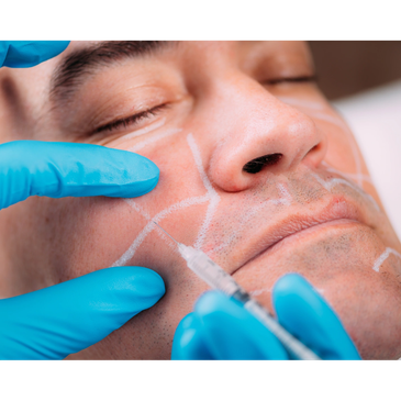 Dermal fillers can bring back lost volume. We use dermal fillers for both men and women for the mid 