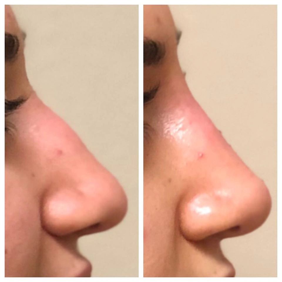 voluma non-surgical rhinoplasty