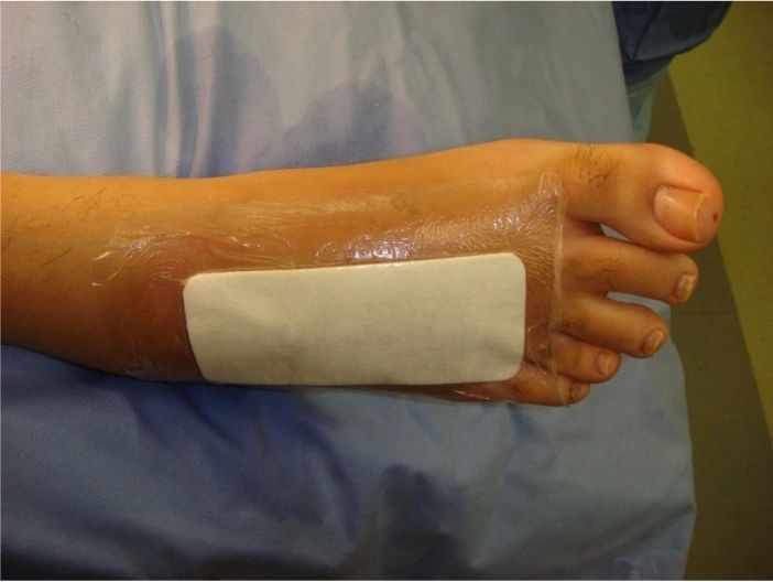 After exfix removal After exfix removal