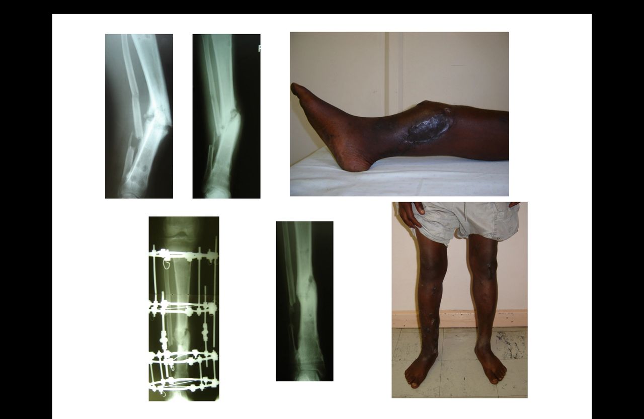 Ilizarov treatment of a tibial non-union Ilizarov treatment of a tibial non-union