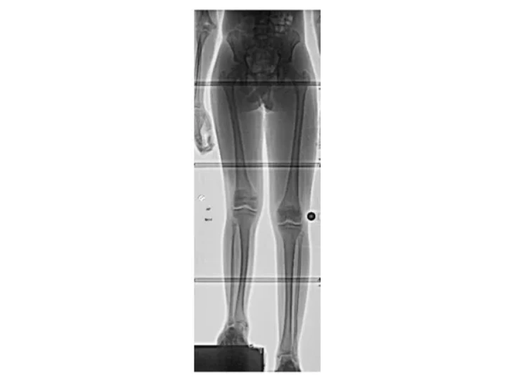 Fibular Hemimelia. Lengthening. Limb Lengthening. Leg Lengthening.