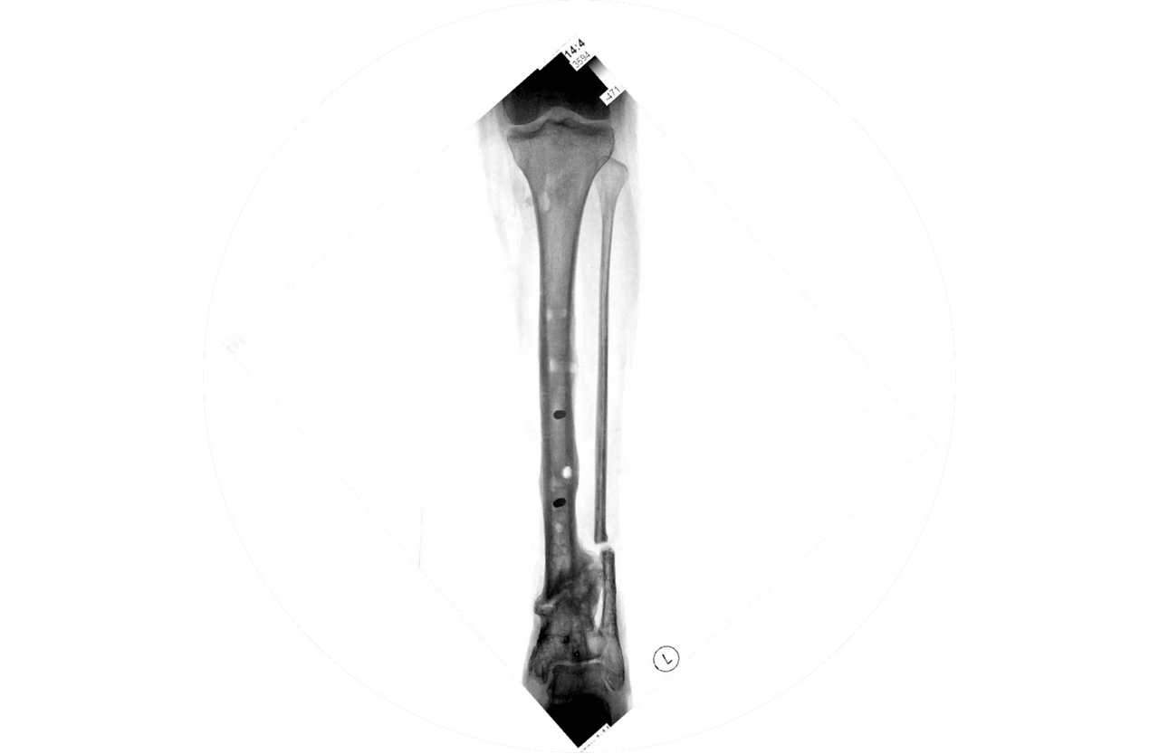 United and aligned tibial non-union United and aligned tibial non-union