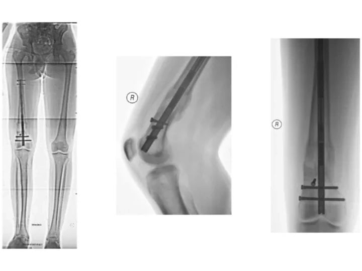 Precice Nail Femur Lengthening