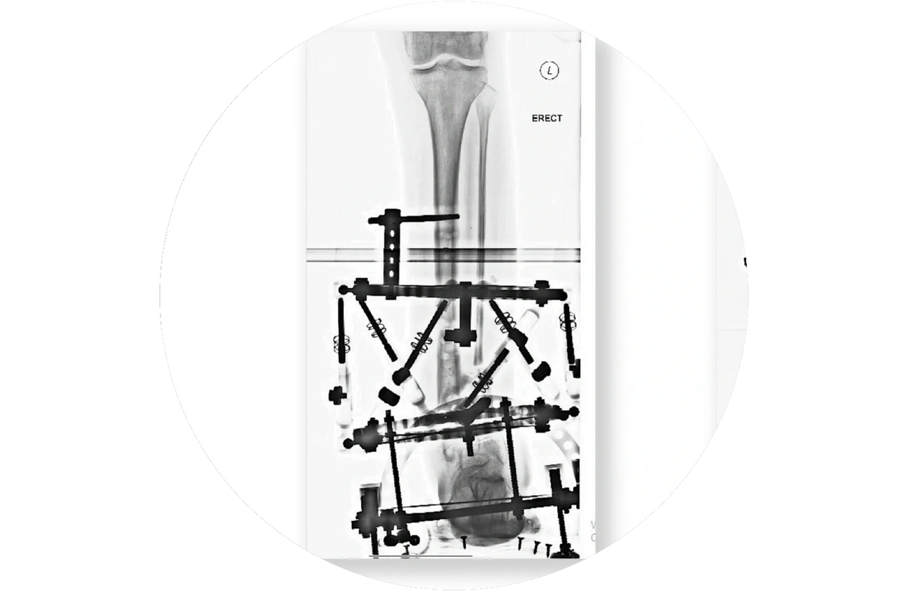 Hexapod External Fixator Hexapod External Fixator