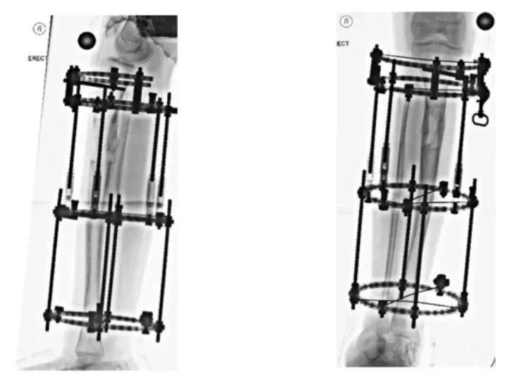 Ilizarov. Tibial Lengthening. TLHex. TSF. Leg Lengthening.