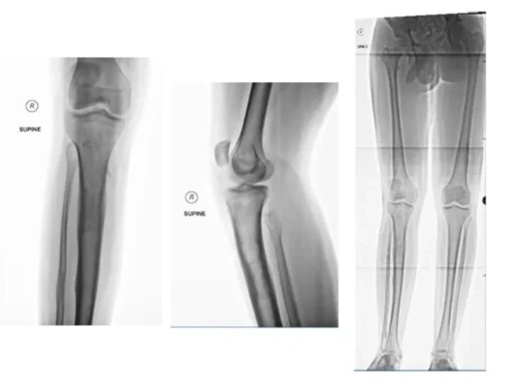 Short femur for lengthening