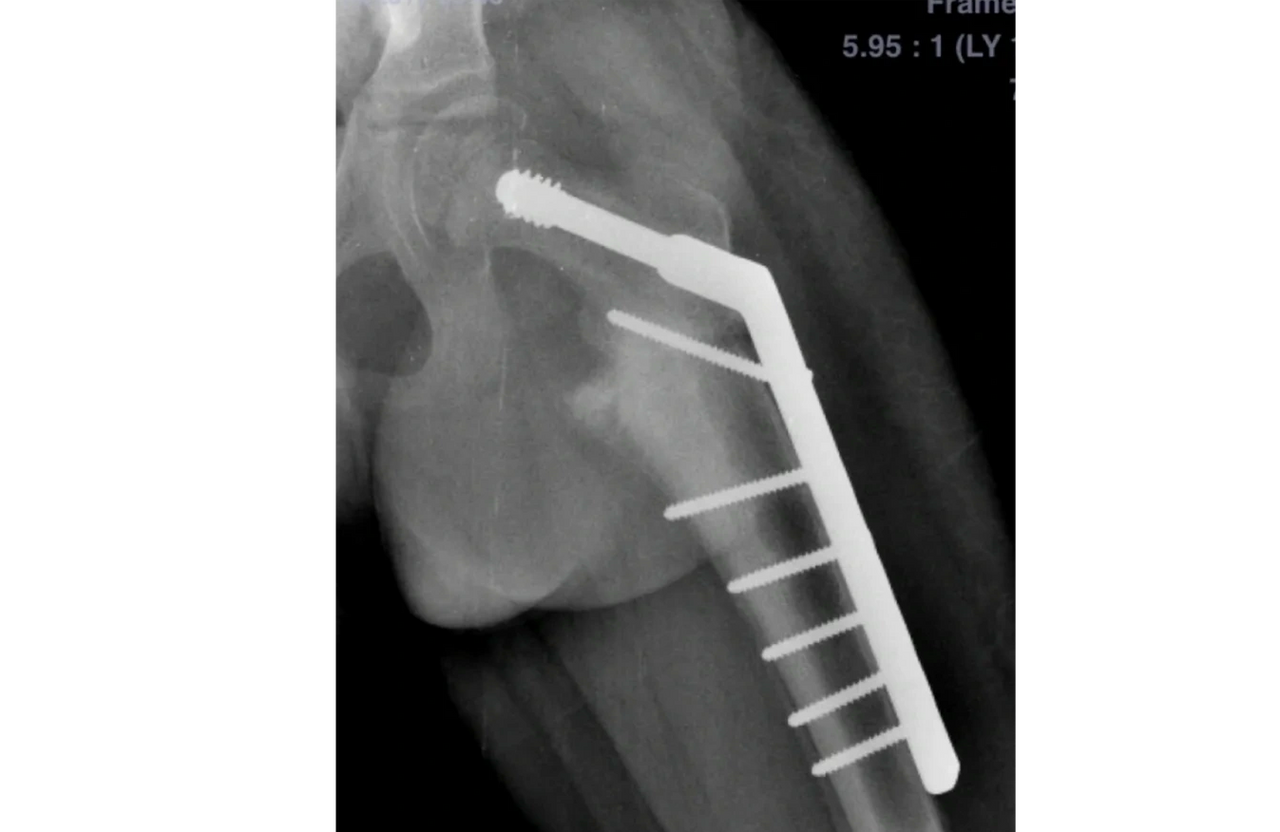 Non-union of Proximal Femur treated with Internal Fixation Non-union of Proximal Femur treated with Internal Fixation
