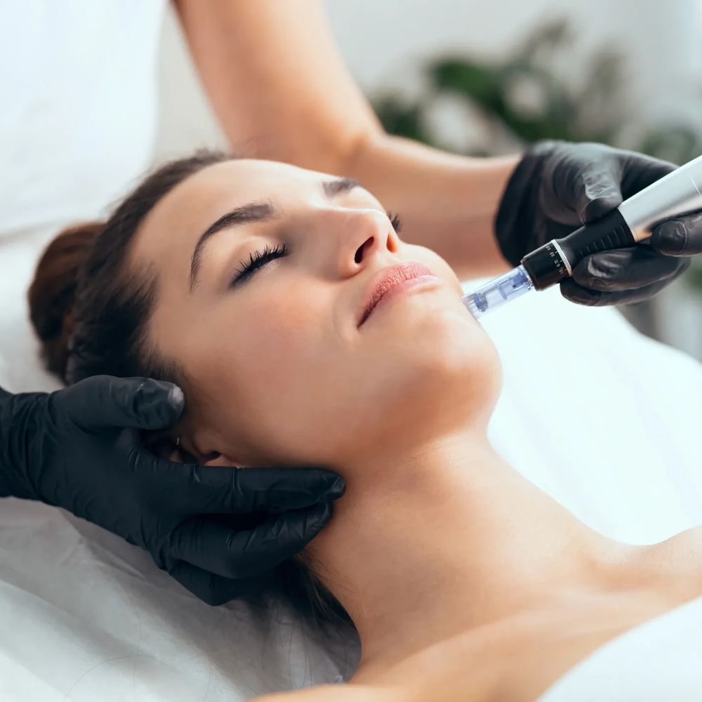 Woman receiving a microneedling facial treatment at a spa.