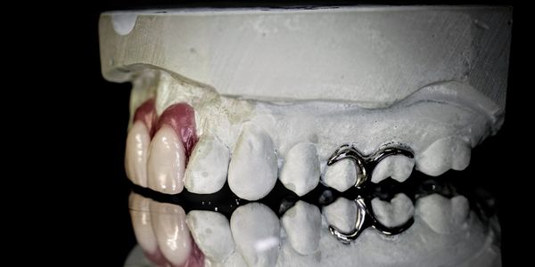 Cast Metal partial Dentures