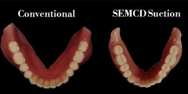 Lower Suction Dentures