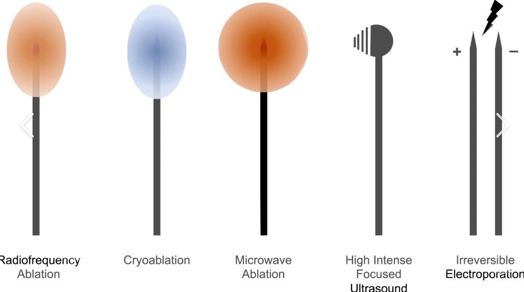 Visual comparison of five tissue ablation techniques.