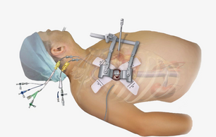 Mini-Thoracotomy
Sternum sparing
Minimally Invasive Cardiac Surgery
Minimally Invasive Heart