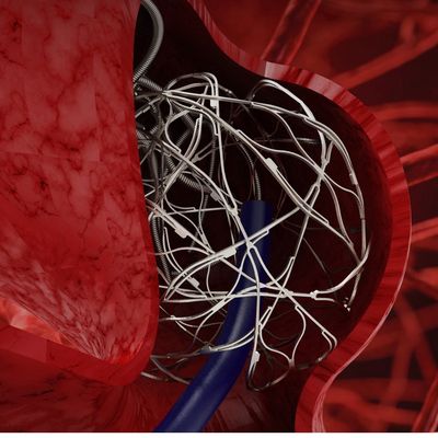 Syntra Intrasaccular Coil-Assist Device:  Complex Irregular Acute Angulated Aneurysm Access 