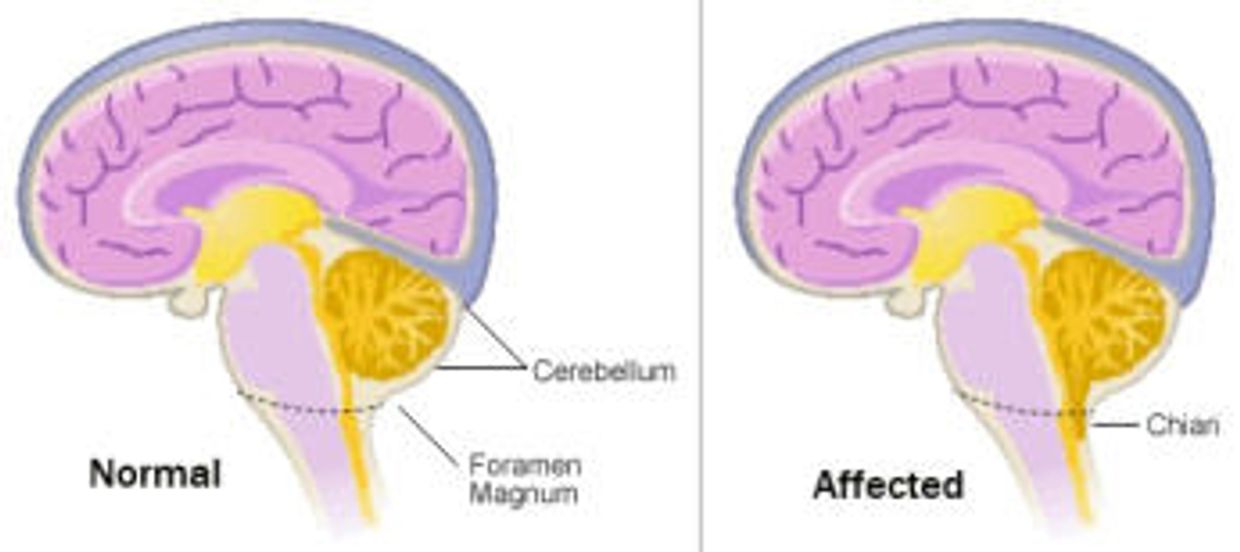 Chiari Malformation